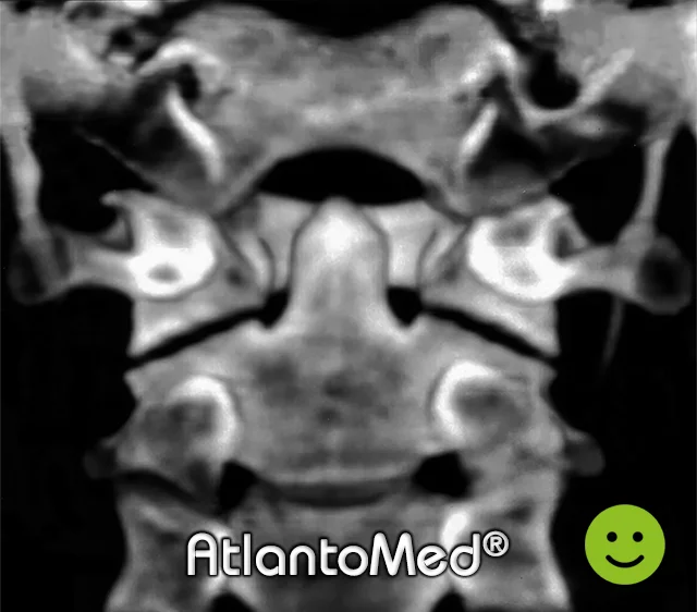 CT-spirale Atlas et axis avant et après l'alignement de l'Atlas