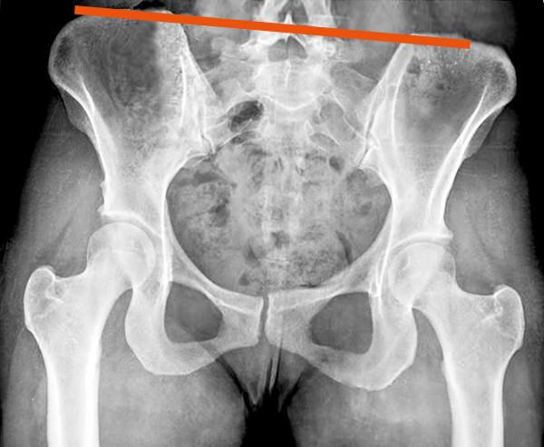 Radiographie du bassin incliné
