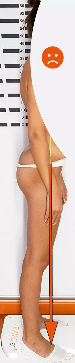 Posture oignon du pied avant et après