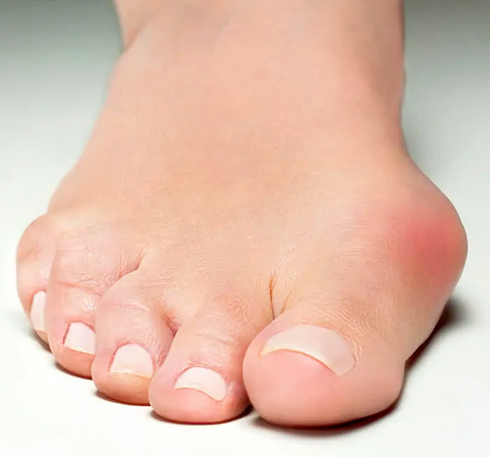 Solution pour oignon du pied