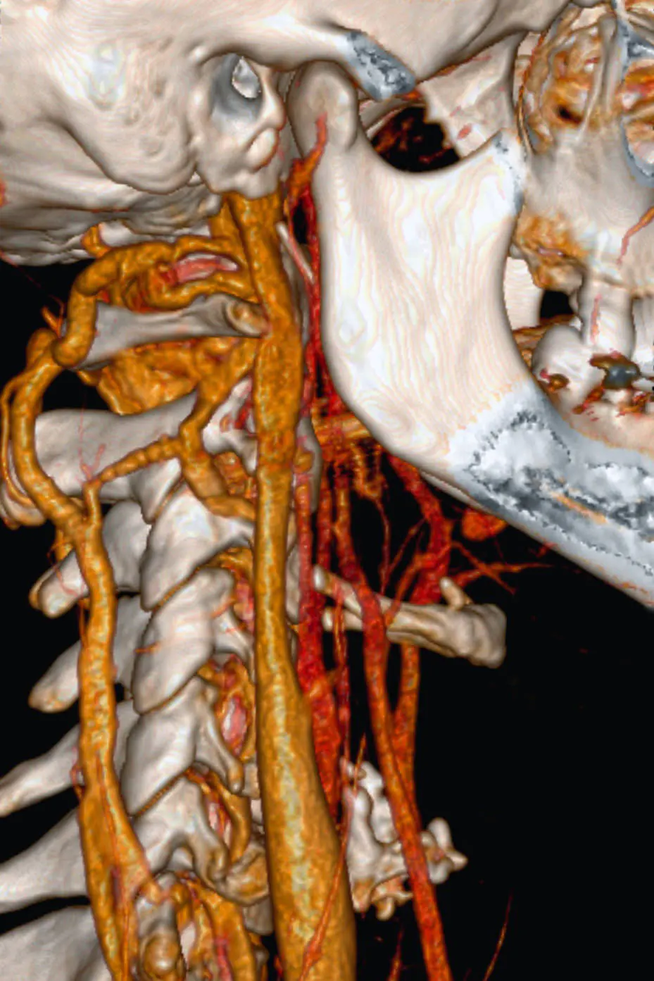Angiographie cervicale CT Angiographie cervicale CT