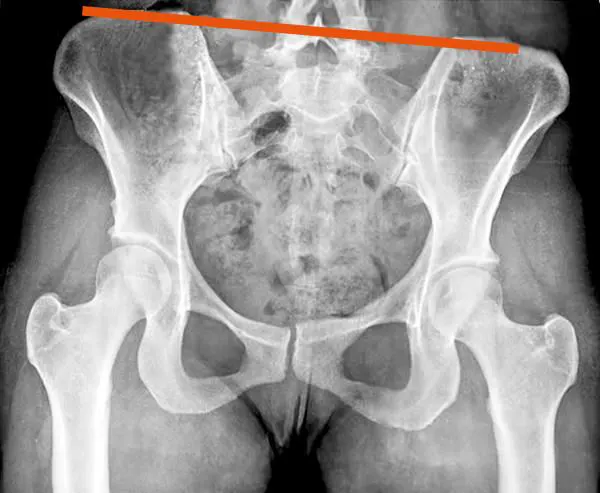 Radiographie du bassin incliné