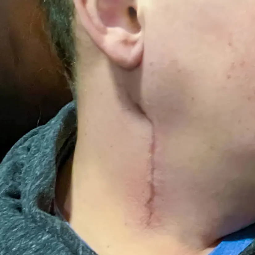 Chirurgie et rectitude du rachis cervical Chirurgie et rectitude du rachis cervical