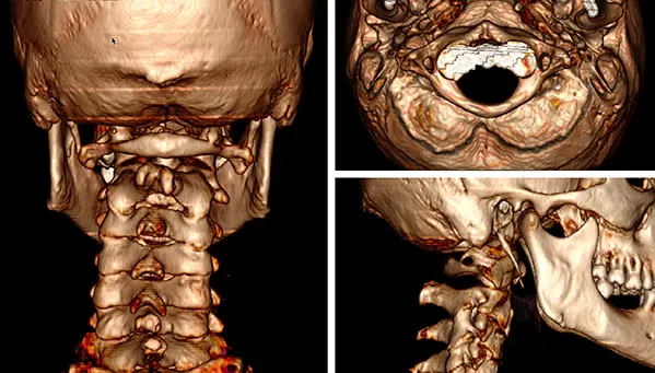 Tomodensitométrie cervicale
