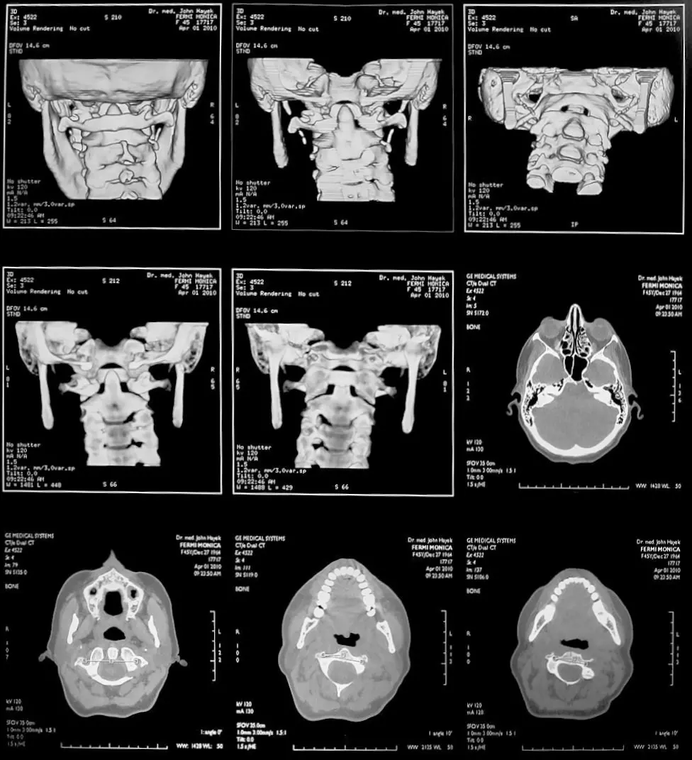 CT spirale / Tomographie du crâne et de la vertèbre Atlas
