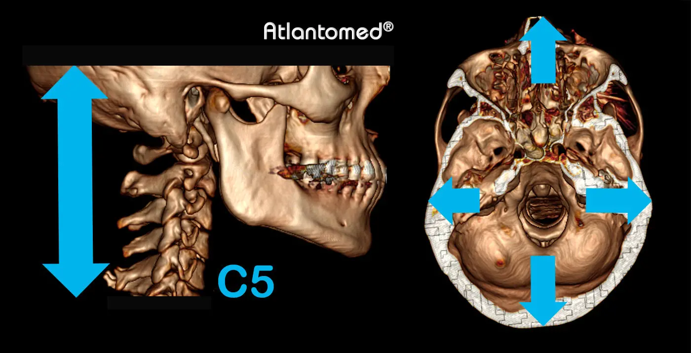 Scanner spiralé du crâne et cervical avec Atlas et Epistrophée