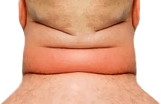 Cou de taureau Cou de taureau