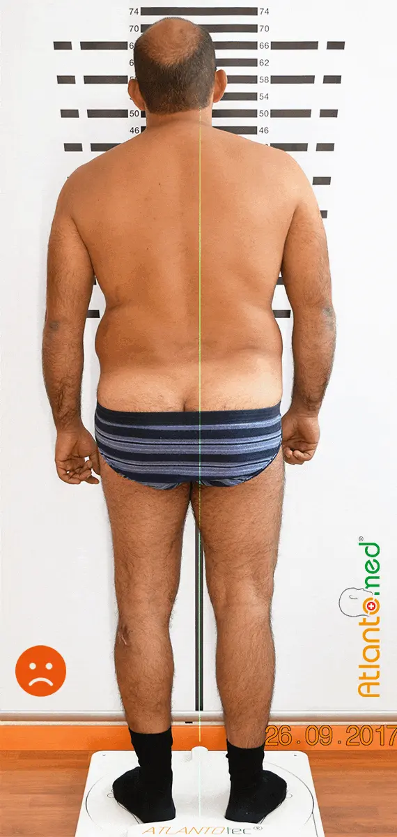 Amélioration de la posture après la correction de l'Atlas