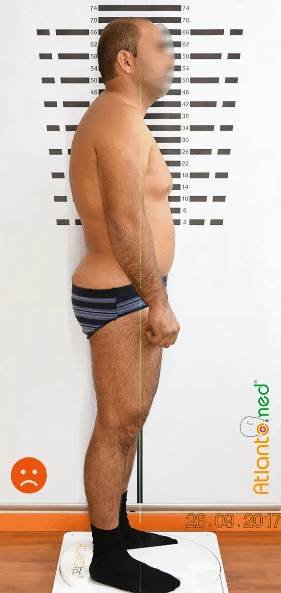 Changement postural après le réalignement de l'Atlas