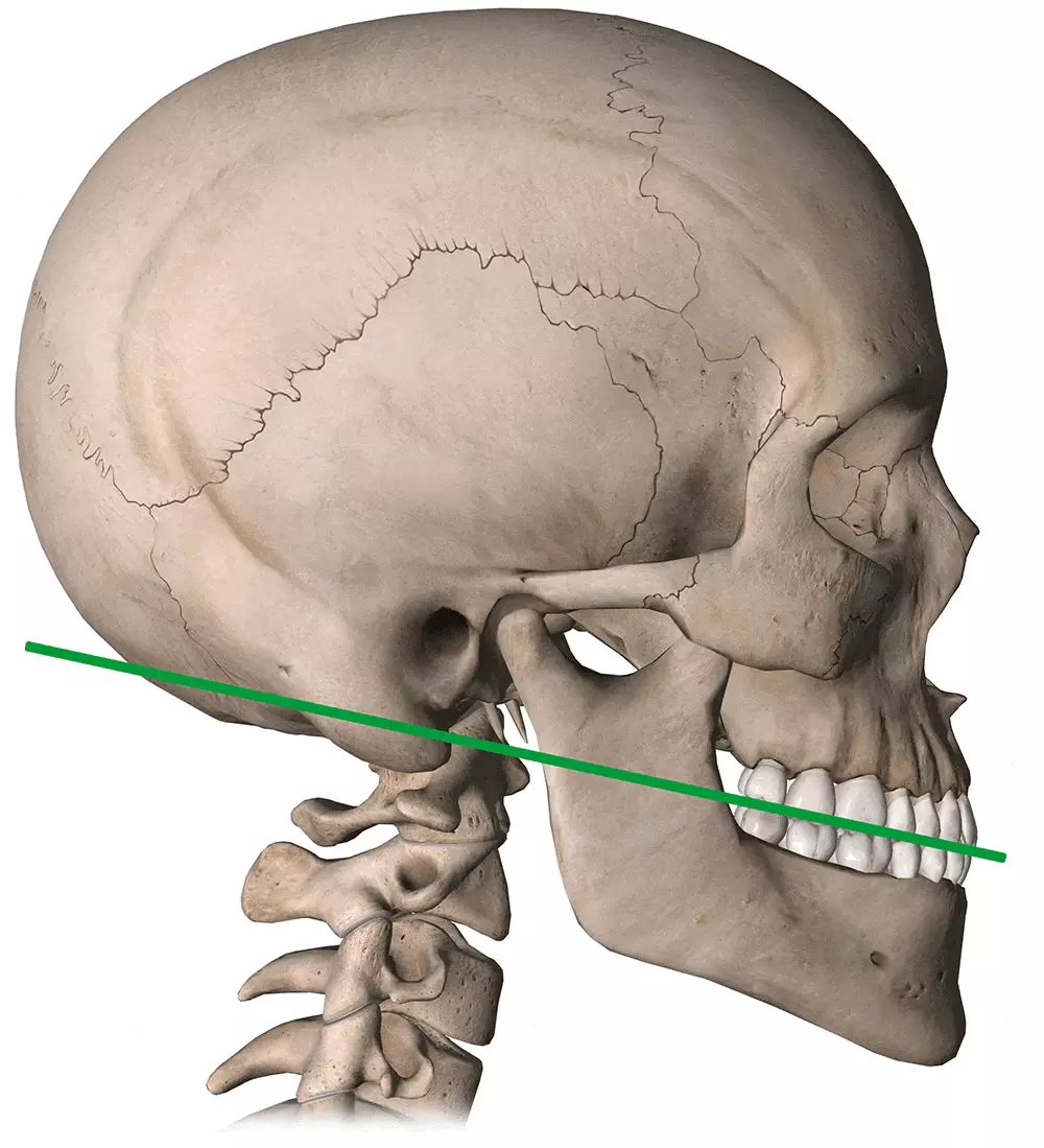 Rectitude du rachis cervical et mâchoire déviée Rectitude du rachis cervical et mâchoire déviée