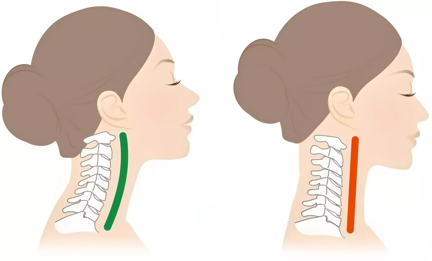 Rectitude du rachis cervical