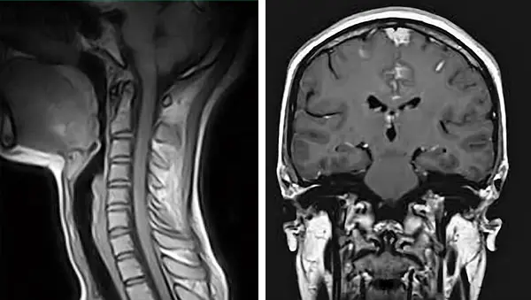 Imagerie par résonance magnétique cervicale