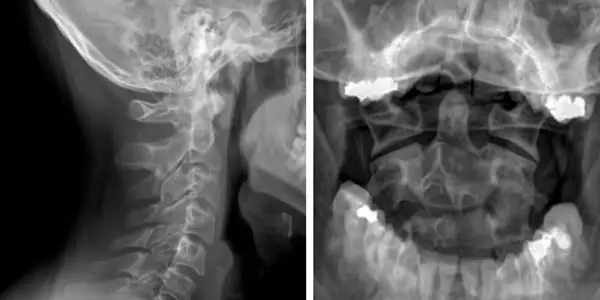 Radiographie cervicale et intraorale